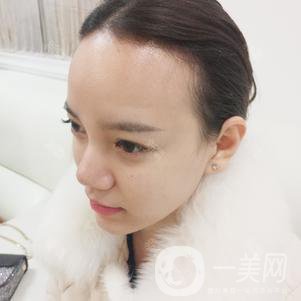 植發(fā)半年后案例 植發(fā)怎么樣？