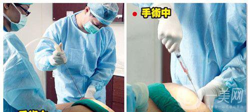 什么是抽脂手術(shù)？*果好嗎？