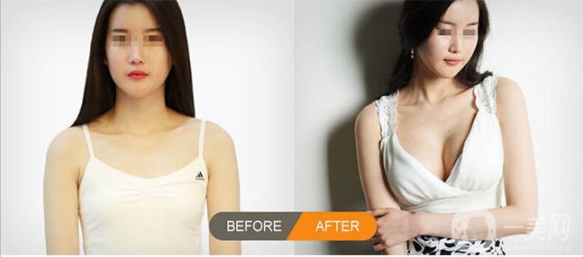 什么是隆胸手術 乳房植入物類型