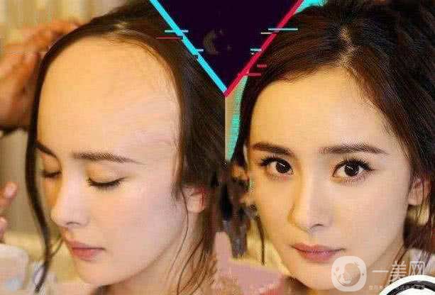 植發(fā)需要多少錢(qián) 植發(fā)多久恢復(fù)呢