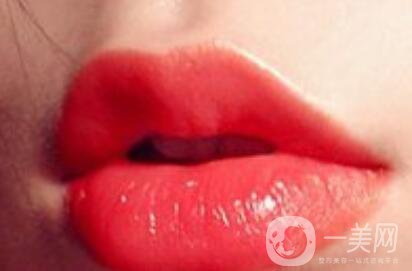 玻尿酸豐唇怎么打 有哪些方式 