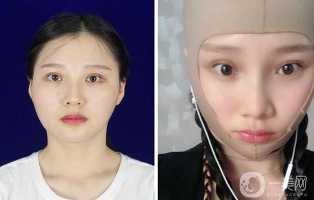 下頜角手術(shù)