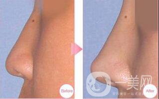 耳軟骨做鼻子,后遺癥有哪些,如何避免