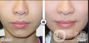 自體脂肪豐下巴費(fèi)用,自體脂肪豐下巴*果