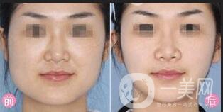 下頜角術(shù)后戴多久頭套,下頜角術(shù)后飲食,下頜角術(shù)后注意事項