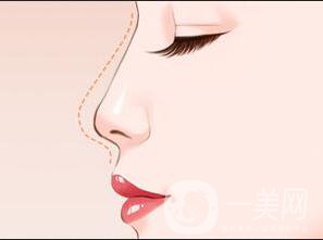 耳軟骨隆鼻能保持多久,耳軟骨隆鼻多少錢