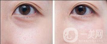 眼部*多少錢(qián)