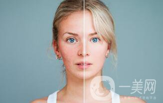 光子嫩膚多久做一次比較好？