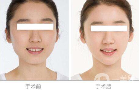 自體脂肪墊下巴恢復(fù)期 *果好不好