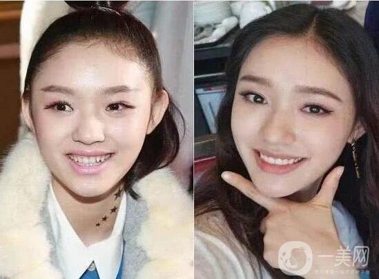 明星正畸牙齒矯正