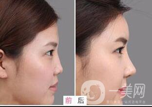 鼻子綜合整形多少錢