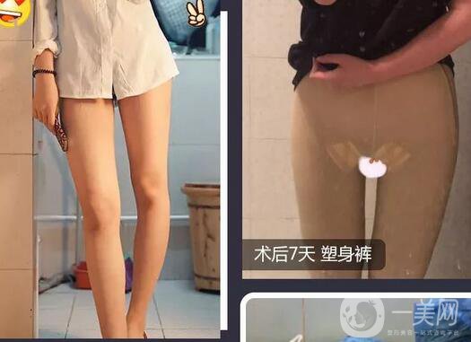 腿部環(huán)形抽脂*果,腿部環(huán)形抽脂多少錢