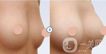 硅膠隆胸怎么樣？硅膠隆胸恢復(fù)期多久？