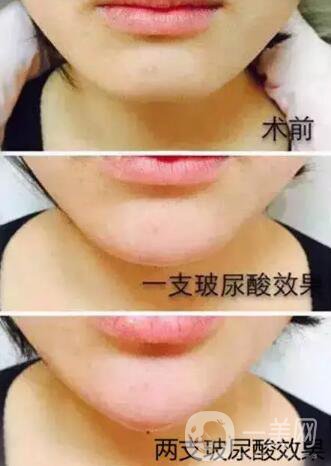 玻尿酸豐下巴需要幾針？?jī)舍槻Ｄ蛩嵯掳?果圖