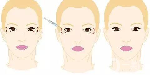 打一針除皺多少錢 打*停了會更老嗎