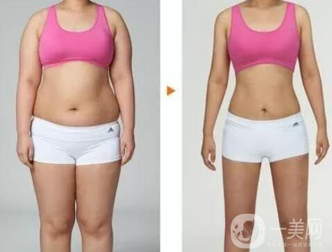 360度環(huán)形吸脂