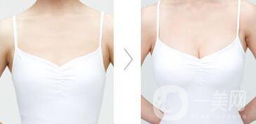 假體隆胸的材料有哪些