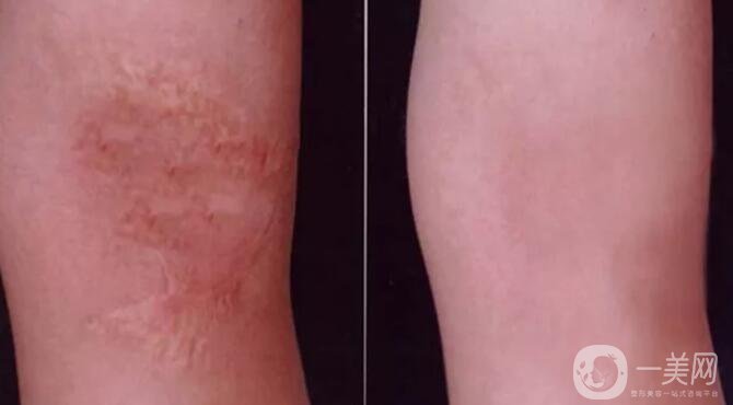 激光修復(fù)疤痕,副作用,凹陷疤痕