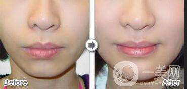 假體下巴風(fēng)險