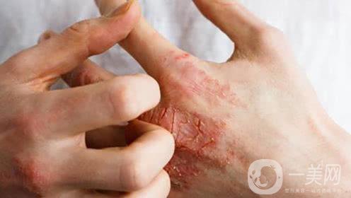 激光祛疤手術(shù)*果怎么樣 激光祛疤結(jié)痂圖片