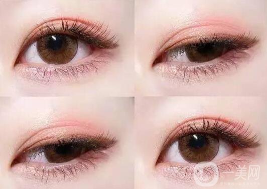 雙眼皮手術,并發(fā)癥