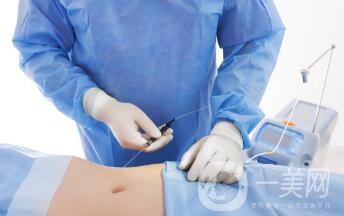 等離子激光溶脂怎么做?激光溶脂手術(shù)過程詳解