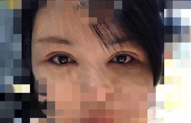 處楊曉楠雙眼皮案例 楊曉楠醫(yī)生怎么樣？
