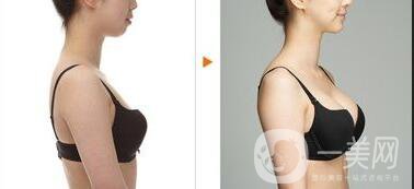 假體隆胸,維持多少年