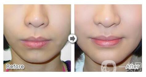 硅膠隆下巴后遺癥,硅膠隆下巴價格