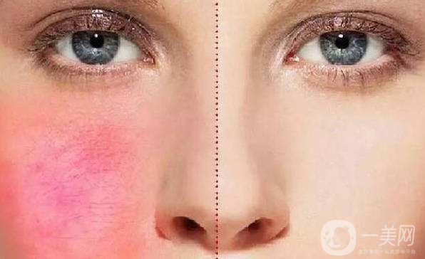 北京激光去紅血絲多少錢?