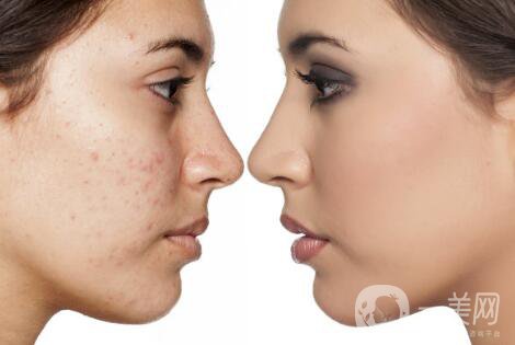 黑臉娃娃去痘*果好嗎？黑臉娃娃功*介紹