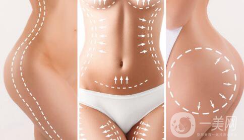 環(huán)形吸脂減肥是什么？吸脂后皮膚會不會松弛？