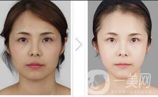 面部纖維溶解手術(shù)