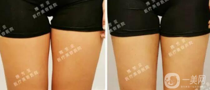 水動力溶脂減肥,*果