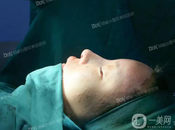 自體脂肪填充臉真人案例：路人到仙女的蛻變