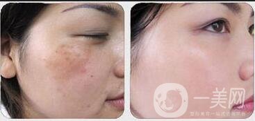 *風(fēng)范祛斑*果,*風(fēng)范祛斑多少錢