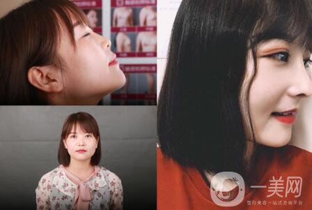 隆鼻前后照片分析 專家解析：隆鼻前后的變化