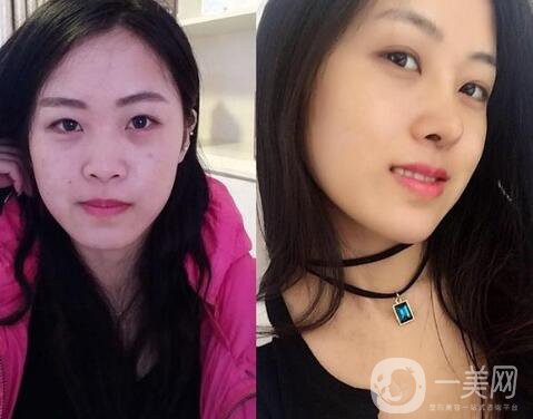 隆鼻前后照片分析 專家解析：隆鼻前后的變化