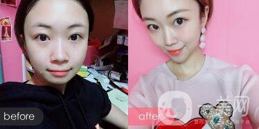 隆下巴手術(shù)前后*果圖 隆下巴的風(fēng)險和恢復(fù)