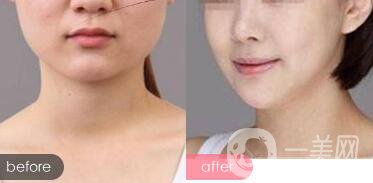 隆下巴手術(shù)前后*果圖 隆下巴的風(fēng)險和恢復(fù)