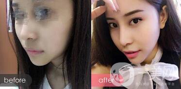 隆下巴手術(shù)前后*果圖 隆下巴的風(fēng)險和恢復(fù)