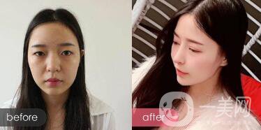 綜合鼻整形多少錢？綜合鼻整形收費