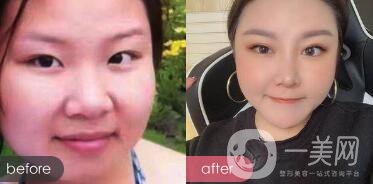 蒜頭鼻整形圖片 蒜頭鼻整形多少錢？