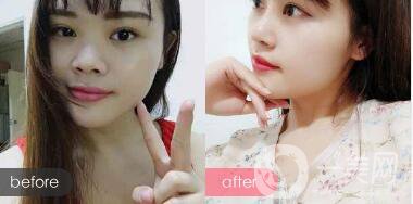 蒜頭鼻整形圖片 蒜頭鼻整形多少錢？