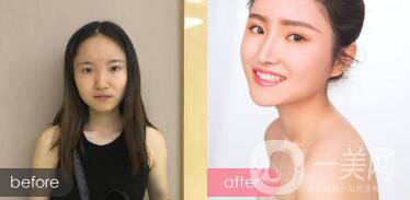 蒜頭鼻整形圖片 蒜頭鼻整形多少錢？