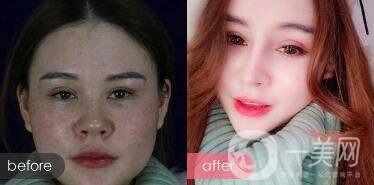 注射隆鼻整形多少要錢？微整形注射隆鼻過程