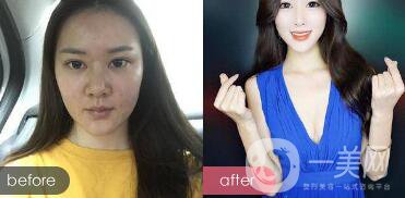 注射隆鼻整形多少要錢？微整形注射隆鼻過程