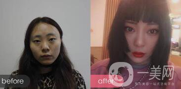 成都眼部整形專題 明星眼部整形