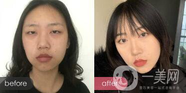 成都開(kāi)眼角多少錢(qián)呢？開(kāi)眼角案例