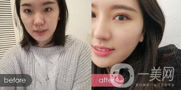 成都開(kāi)眼角多少錢(qián)呢？開(kāi)眼角案例